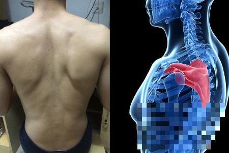 >右侧后背肩胛骨处疼痛怎么办 教你几招快速治疗