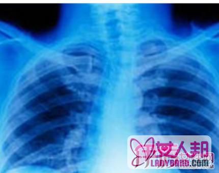 >揭秘小细胞肺部肿瘤的原因  肺部肿瘤的临床表现及治疗