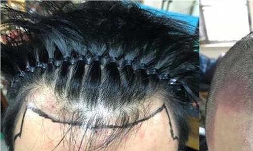 发际线是什么位置 广州雍禾植发发际线种植的效果怎么样?