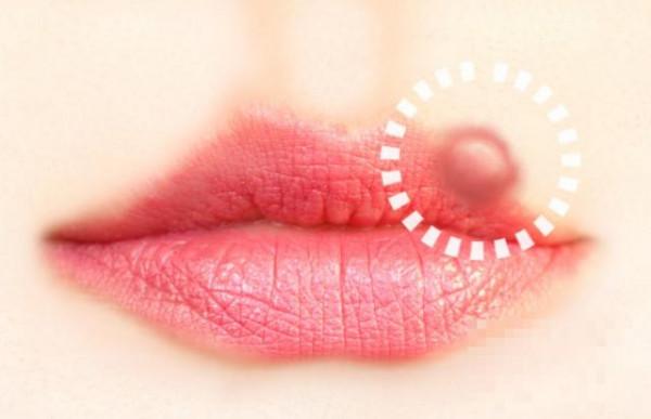 嘴唇长泡破了怎么办 详解7种有效的解决方法