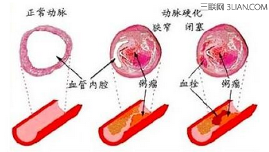 >糖尿病就是心血管疾病