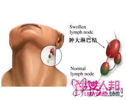 淋巴结肿大症状  5个症状分析让你更了解淋巴结