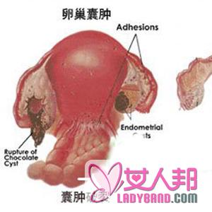 【卵巢囊肿多大需手术】卵巢囊肿手术后吃什么_卵巢囊肿的治疗方法
