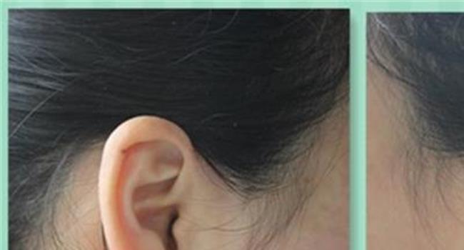 耳结石是怎么形成的
