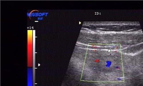 >肝回声稍粗还能恢复吗 肝回声增粗可以恢复吗