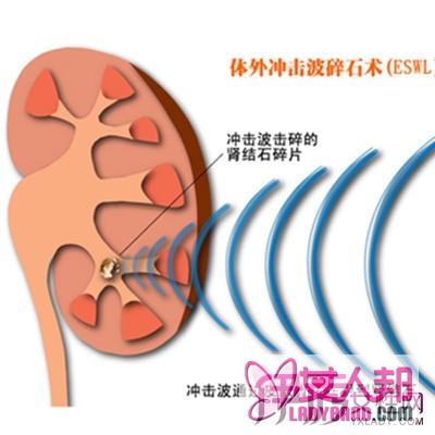 >体外震波碎石图片欣赏　４大点注意事项介绍