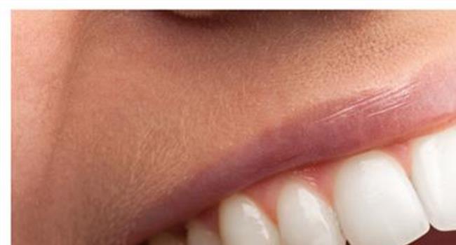 【医生不建议做牙齿美白】医生告诉你哪些人不适合做牙齿美白