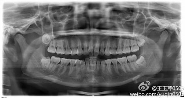 >杨采妮年轻图片 杨采妮拔智齿 脸肿肿被赞更年轻[组图]