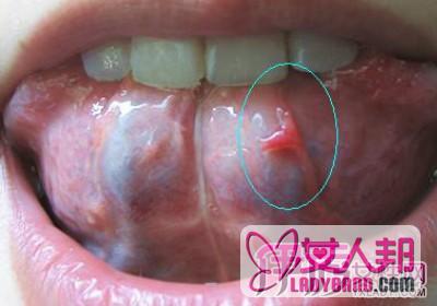 >舌头下长肉芽图片详解 了解病源及治愈方法