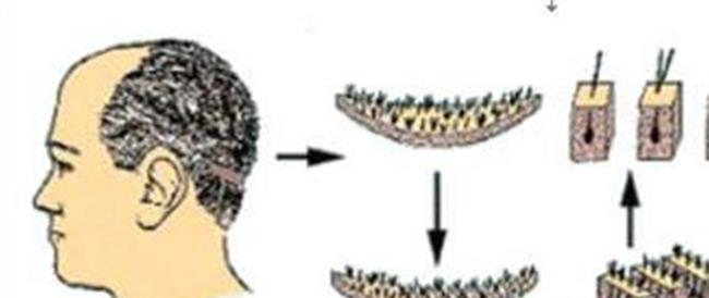 【毛发移植效果怎么样】植发效果对比是怎样 详解什么是毛发移植术
