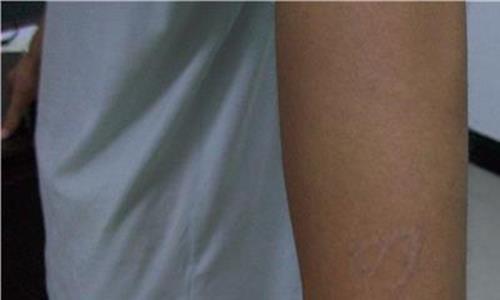 激光洗纹身后的样子 激光洗纹身能恢复以前皮肤的样子吗