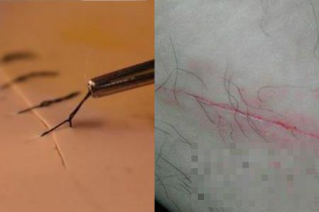 >缝针拆线后注意事项 如何做到不留疤痕