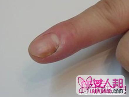 指甲边肿痛是怎么回事 了解指甲健康知识让你远离指甲炎