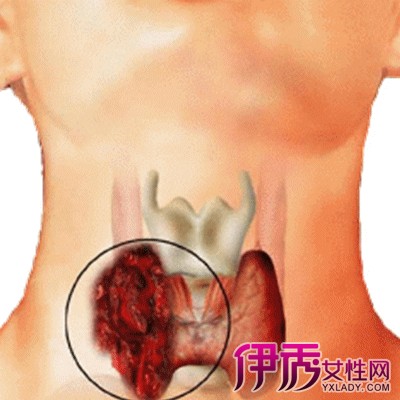 >什么是甲状腺癌症 6大病因介绍甲状腺癌