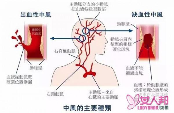 >你离中风有多远？危机早已潜伏，算算你的发病系数吧