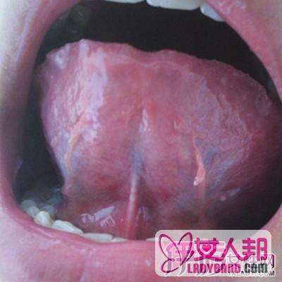 >口腔尖锐湿疣症状介绍 怎样预防口腔尖锐湿疣？