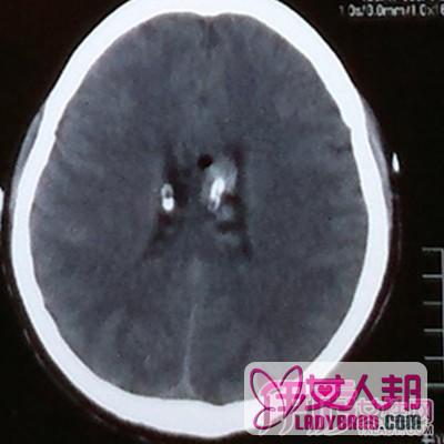 解答重型颅脑损伤的护理 正确的护理方法及早恢复健康