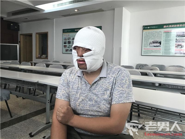 武汉24岁小伙成功换脸 幼时面部因烧伤遭遗弃