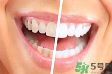 美白牙齿的方法有哪些？美白牙齿有哪些方法？
