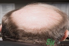 头发稀少的原因是什么？如何预防秃顶的发生？