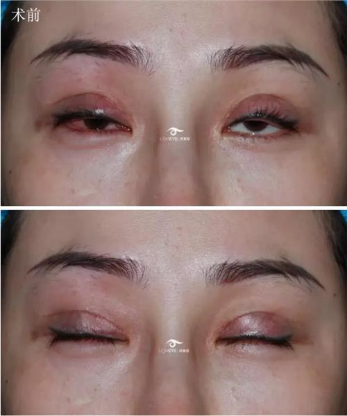 >李永吉双眼皮修复案例 #双眼皮修复案例# 术前术后对比及恢复过程展示