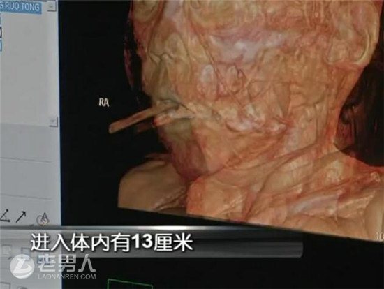 >筷子插进女童大脑4厘米 医生表明稍移动或致死亡