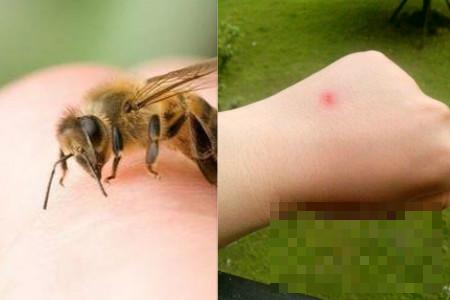 >被蜜蜂蛰了怎么处理 应该做什么紧急措施