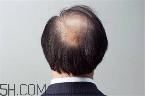 为什么男性比女性更容易脱发？什么原因导致男性脱发？