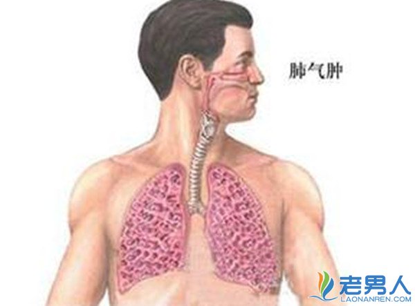 >老年人得了肺气肿会死吗？最佳治疗方案是什么