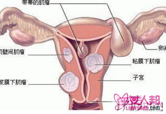 >子宫肌瘤怎么根治？ 三大方法让你快速告别痛苦