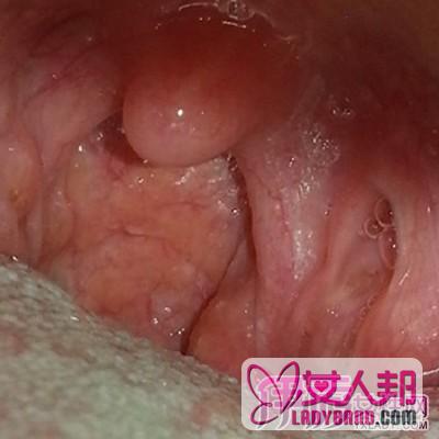 >舌下腺囊肿图片大全  了解其病因及治疗方法