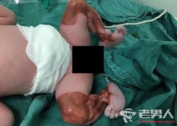 新生儿双腿透明 系患上了小于十万份之一机率的罕见病
