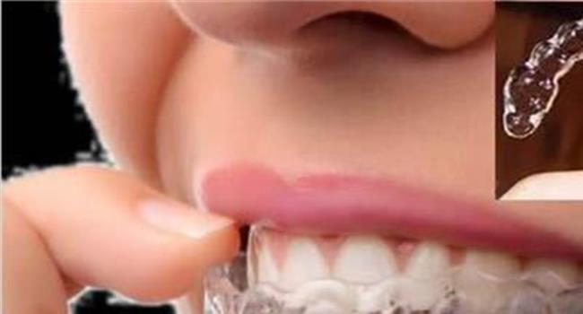 【隐形牙套图片】什么是隐形牙套 什么材质?