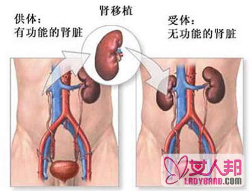 尿毒症能治好吗？