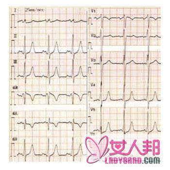 >【心肌梗塞心电图】心肌梗塞心电图是什么_心肌梗塞心电图怎么看