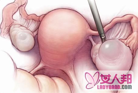 早熟者警惕患上卵巢囊肿
