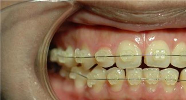 金属牙套和隐形牙套的区别?