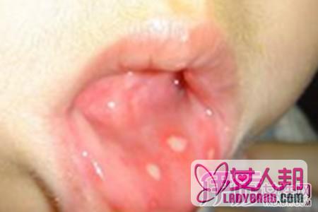 口腔黏膜疾病是什么 它的临床表现有哪些