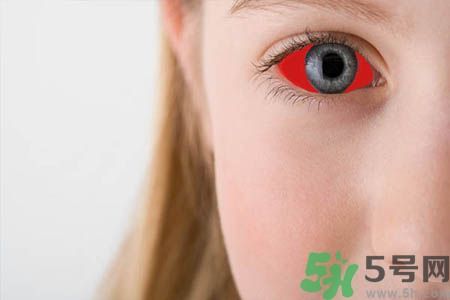 红眼病的表现状态有哪些?红眼病怎么治疗?