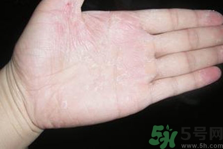 ​手掌脱皮的危害有哪些？如何预防手掌脱皮？