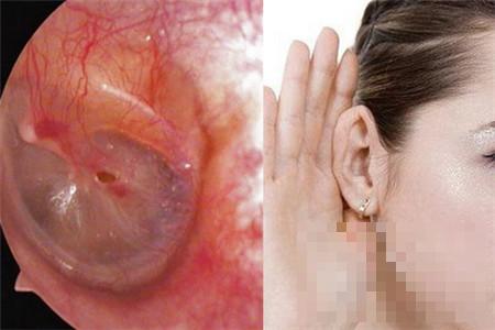 耳膜穿孔手术有什么危害  你的身体需要护理