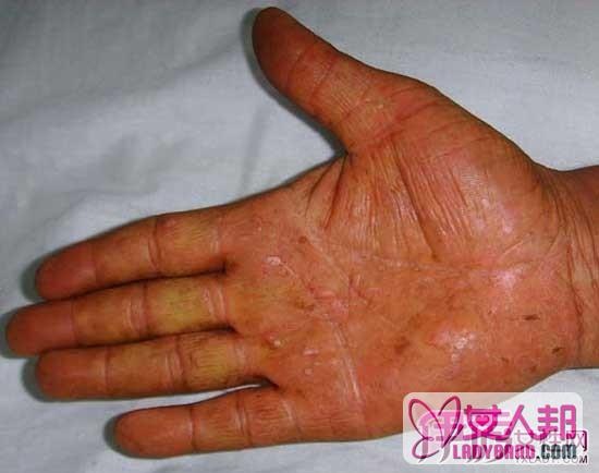 >水疱型手癣会传染吗 水疱型手癣怎么治有哪些治疗方法