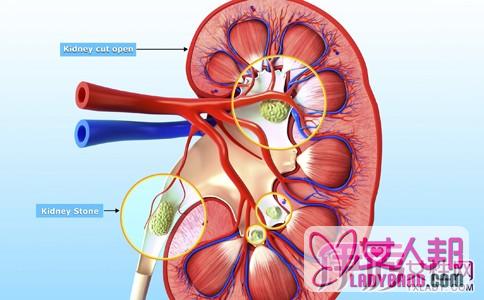肾结石治疗最佳方案是什么 8个诊断肾结石的症状