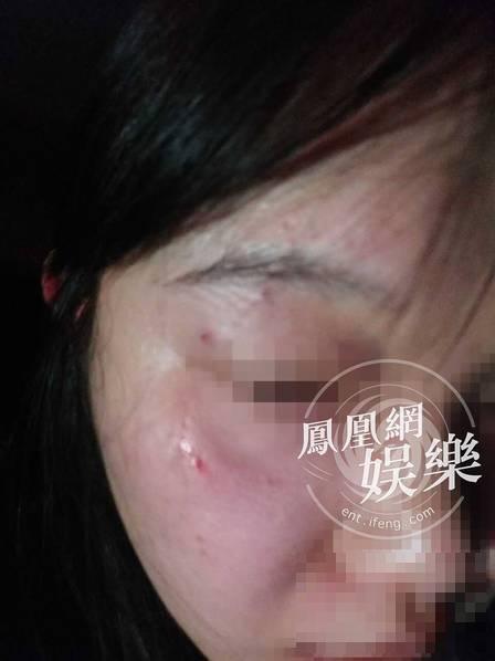 被徐峥殴打女记者照片曝光：肿了半张脸 多处出血|徐峥|摄影师-大陆_华商网娱乐