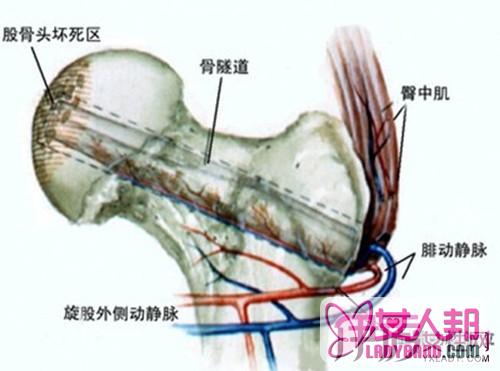 >股骨头坏死有什么症状    股骨头坏死的治疗方法