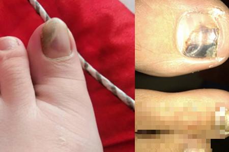 >指甲灰白色是由什么引起的 对身体有危害吗