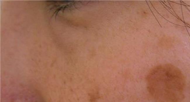 【皮肤色素斑】光子嫩肤可以治疗色素斑