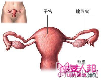 宫腔息肉的症状 术前必须遵守5种检查