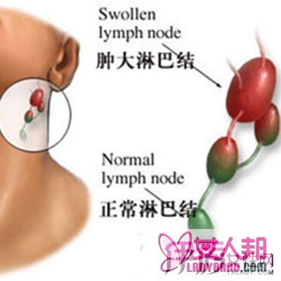 >颈部淋巴结炎症状 教你怎样治疗颈部淋巴结炎