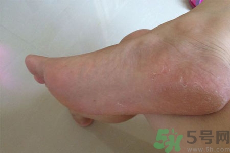 >脚脱皮的治疗方法有哪些？如何预防脚脱皮？